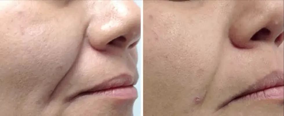 До и После Лечения - Полные Результаты