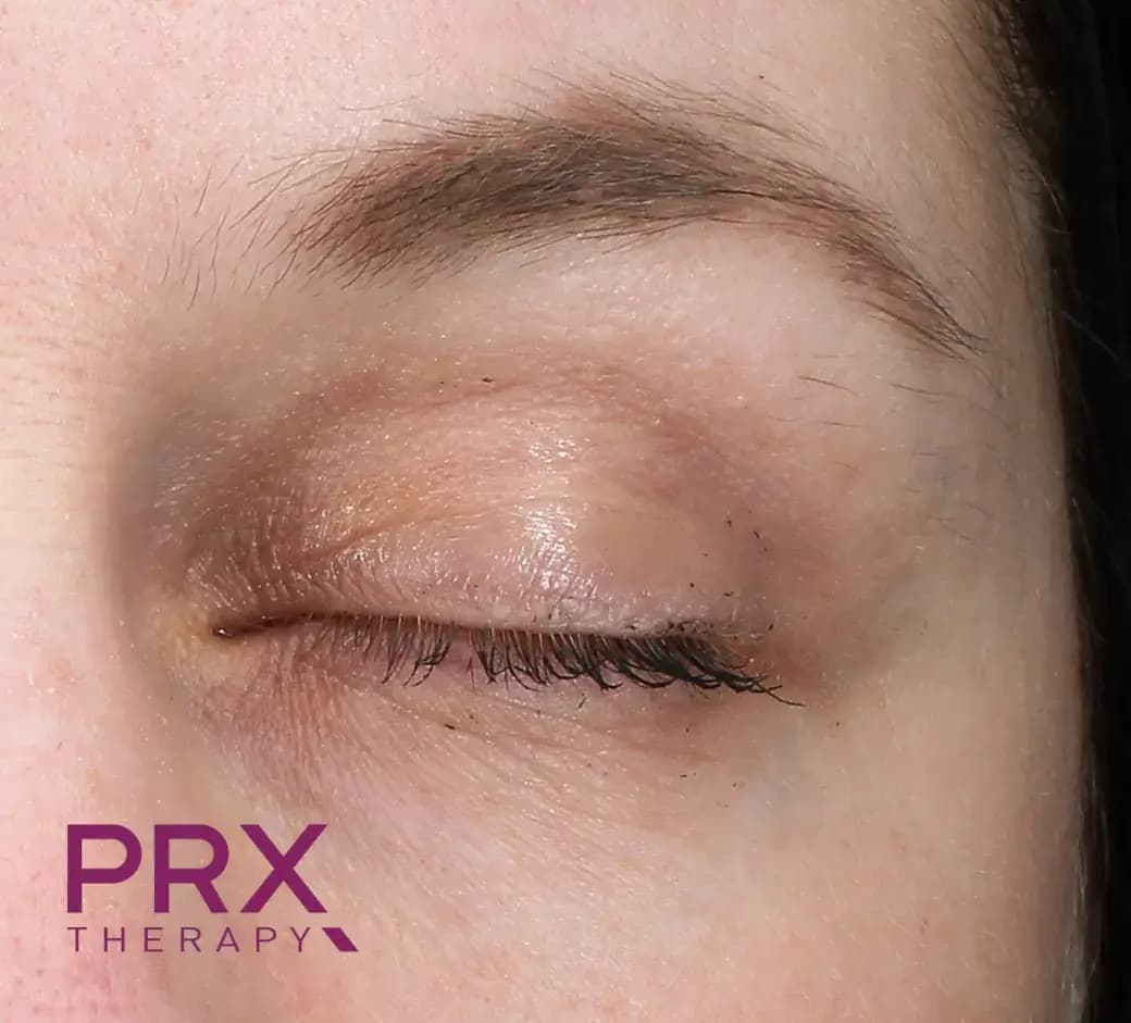 After Верхнее веко и бровь